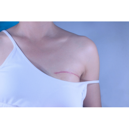 Реконструкция груди SWIM:  новый метод без имплантатов для пациентов с мастэктомией
