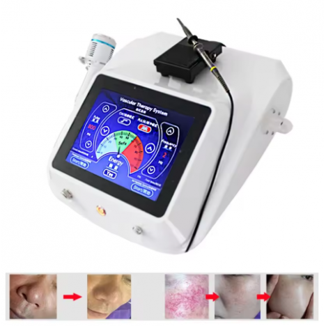 Косметологічний апарат для видалення дрібних судинних утворень VS-90