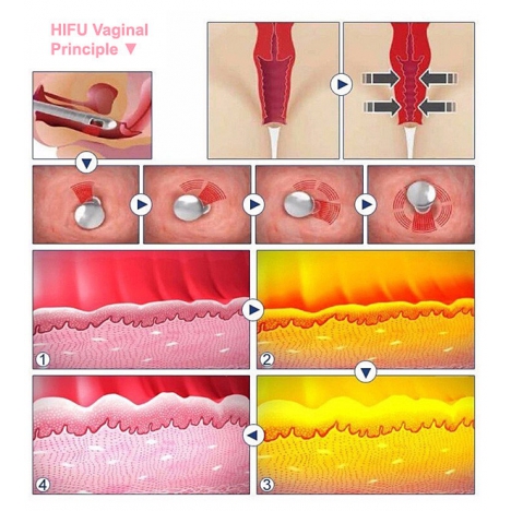 Апарат високоінтенсивного сфокусованого ультразвуку 3 in 1 UMS-HF5 Vaginal + 4D HIFU + Max Machine
