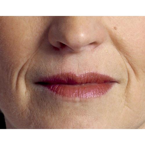 Морщины вокруг губ: лучшее лечение и профилактика