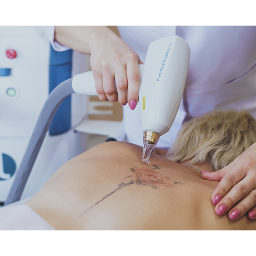 Пикосекундное лазерное лечение татуировок и доброкачественных пигментных поражений кожи