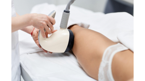 VelaShape: обзор от пациента