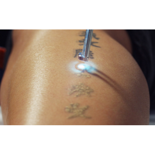 Оптимізація лазерного видалення татуювань