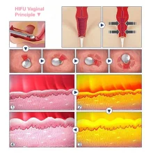 Апарат високоінтенсивного сфокусованого ультразвуку 3 in 1 UMS-HF5 Vaginal + 4D HIFU + Max Machine