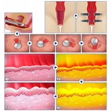 Аппарат HIFU 217