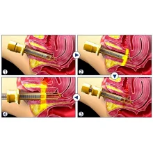 Аппарат HIFU 217