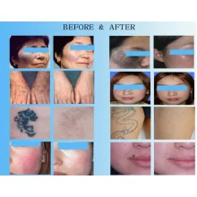 Неодимовий лазер D-Las 70