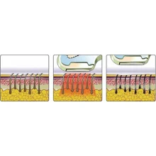 Фотоэпилятор портативный HPLight ( Хепилайт)