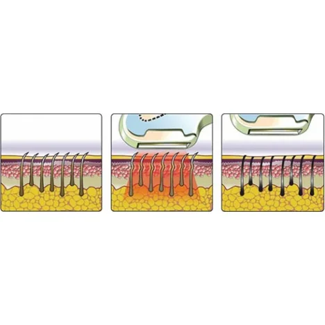 Фотоепілятор портативний HPLight ( Хепілайт)